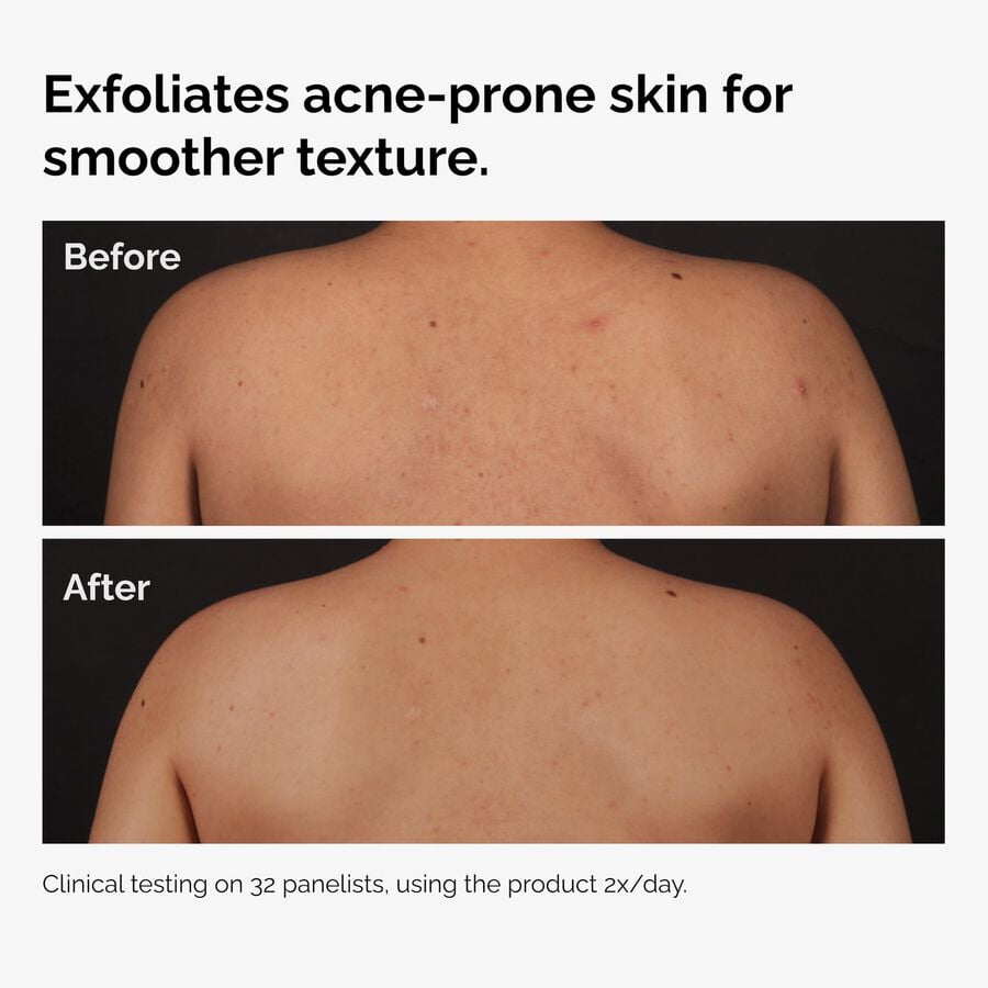 the-body-care-collection-s1 ord-salicylic-acid-body-serum-before-after-graphic-NA.jpg