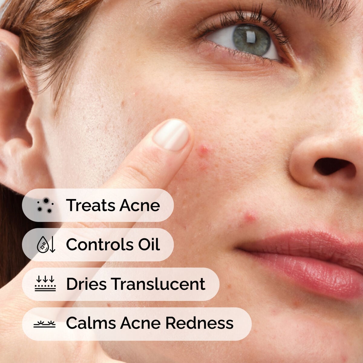 sulfur-10-powder-to-cream-concentrate-y8 ord-sulfur-10pct-powder-to-cream-concentrate-model-application-with-benefits-acne.jpg