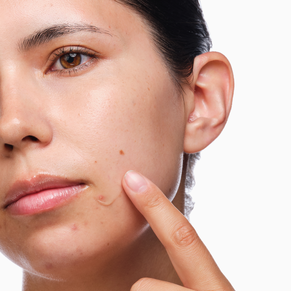 the-acne-set-i9 rdn-the-acne-set-application.png